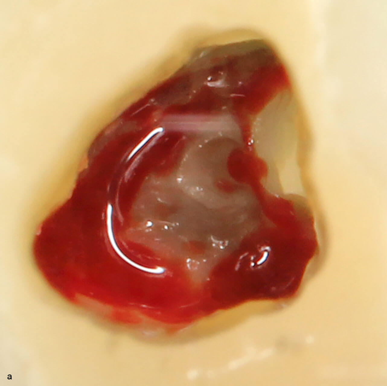 Abb. 14a und b Pulpa: a) nach initialer Eröffnung, b) mit persistierender Blutung aus dem palatinalen Kanal nach Behandlung mit 1 % NaOCl und sterilem Schaumstoffpellet.