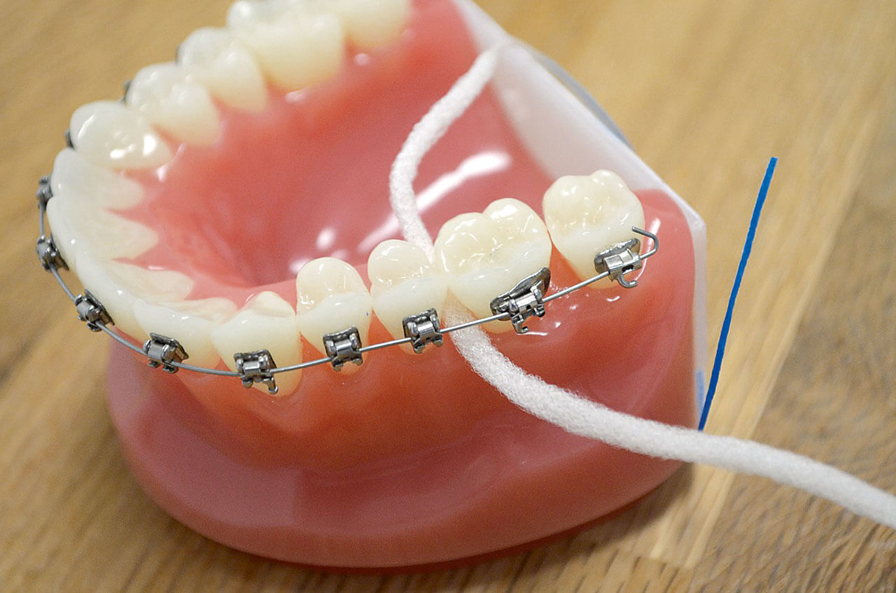 Abb. 5: Interdentalraumpflege trotz Multiband mittels Super-Floss-Zahnseide