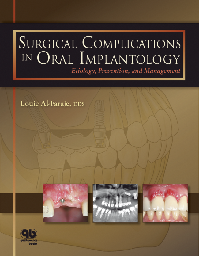 Al-Faraje: Surgical Complications in Oral Implantology