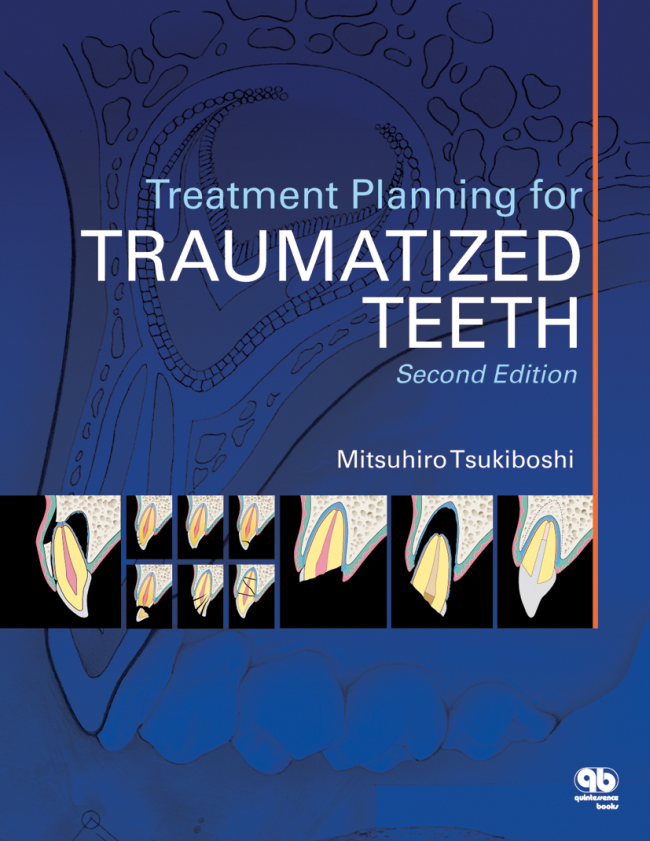 Tsukiboshi: Treatment Planning for Traumatized Teeth
