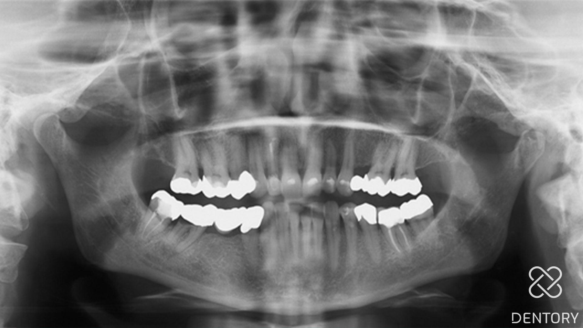 Präoperative Panoramaschichtaufnahme mit apikaler Parodontitis an Zahn 47