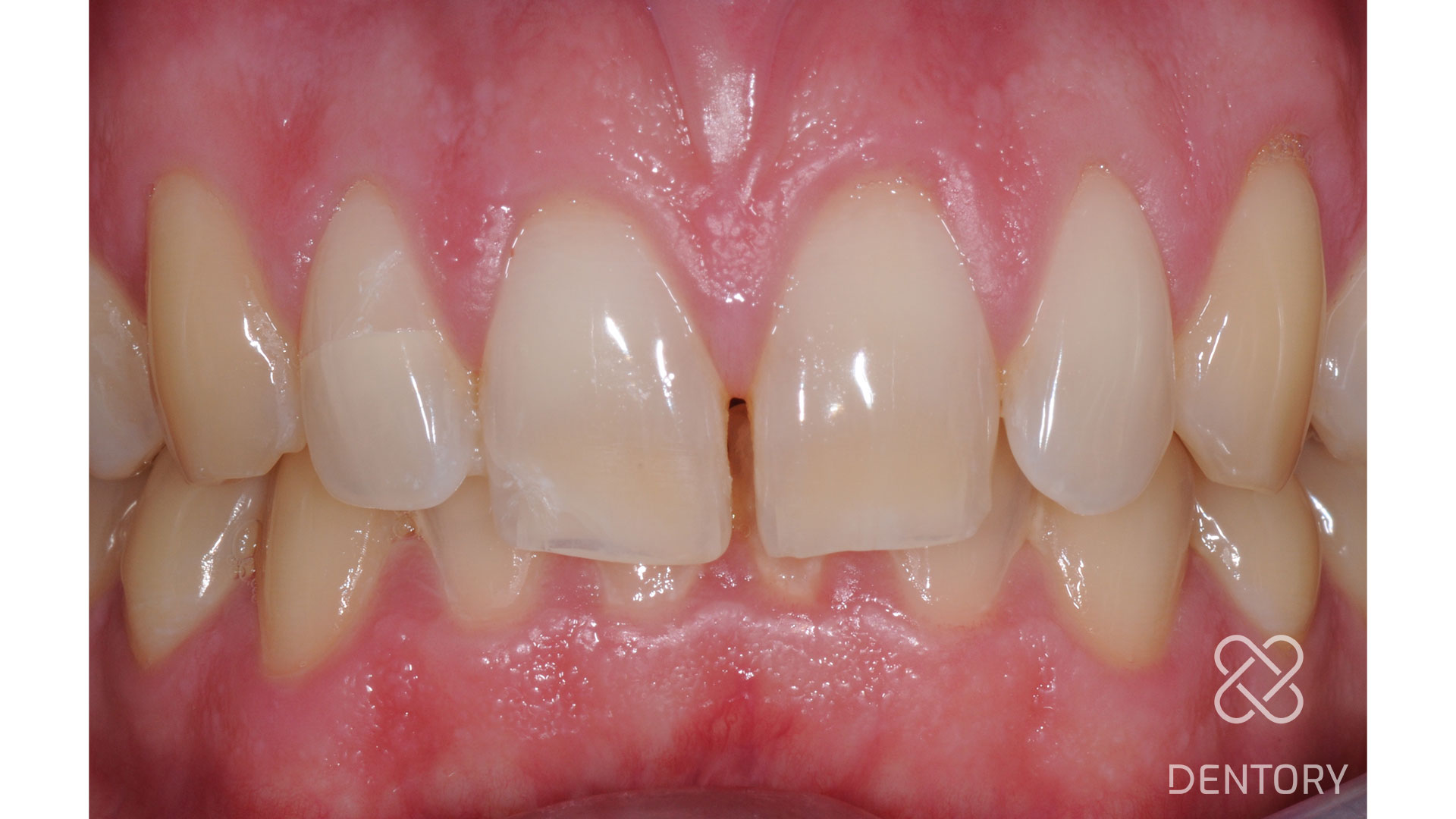 Unkomplizierte Kronen-Wurzel-Fraktur an Zahn 12