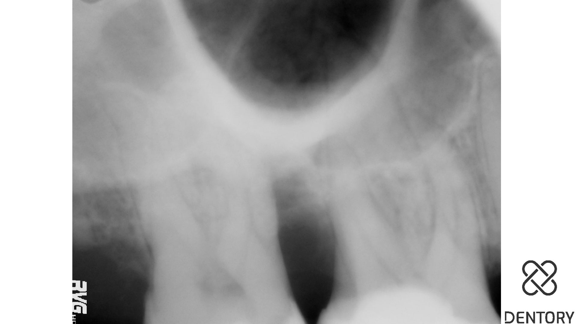 Das Röntgenbild weist einen vertikalen Knochendefekt an Zahn 17 mesial auf.