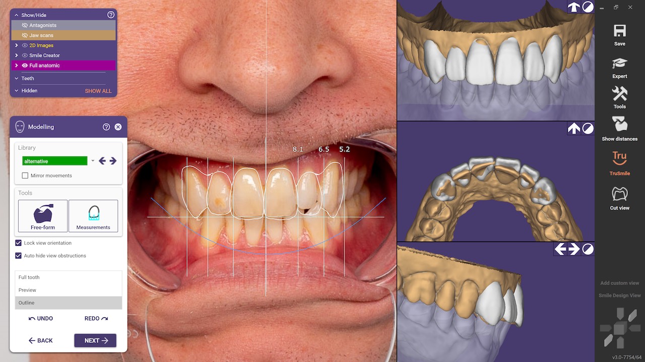 Abb. 5: Die ästhetische Zahnaufstellung wird manuell angepasst.