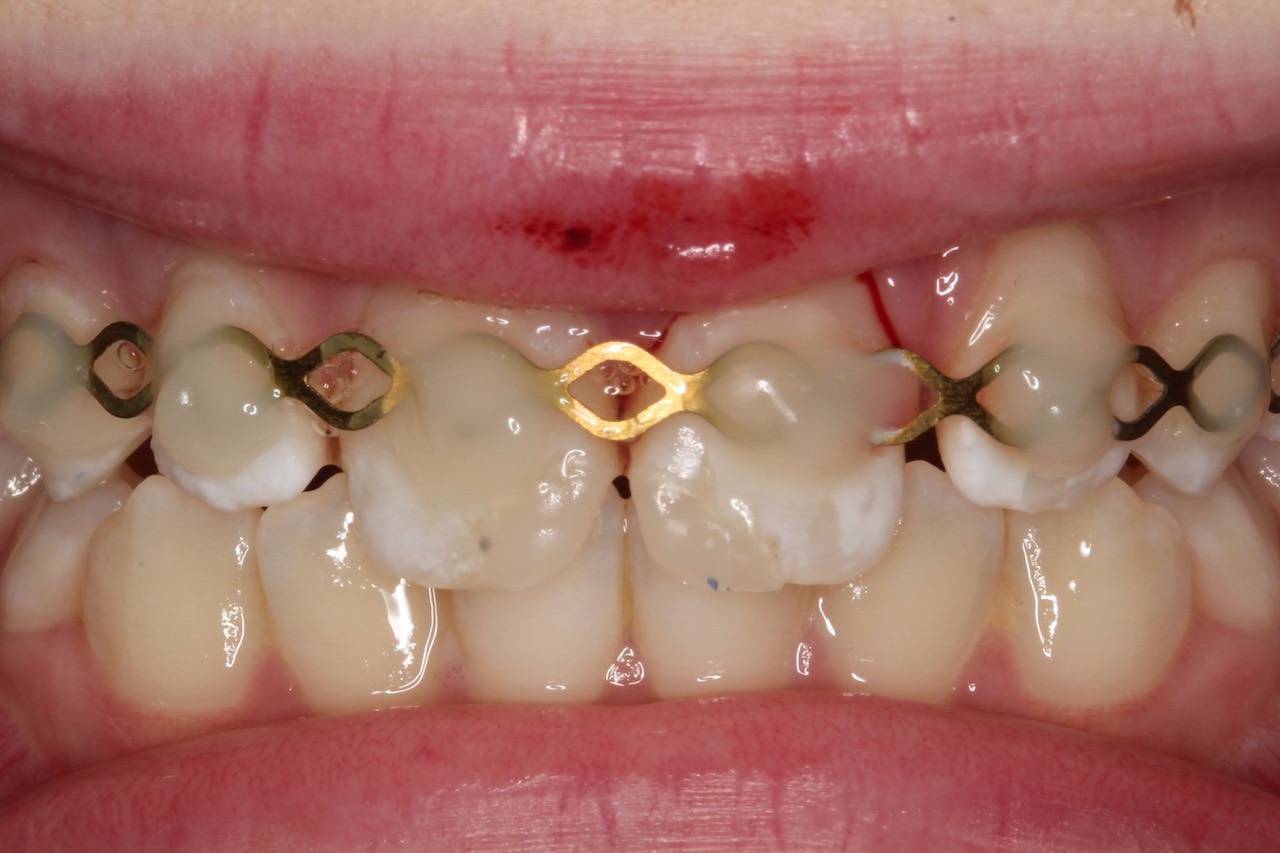 Zustand nach Röntgendiagnostik und Erstversorgung (Schienung mit TTS-Schiene). Die Zähne wurden drei Wochen später mit Komposit aufgebaut und zeigten im weiteren Verlauf keine Auffälligkeiten.