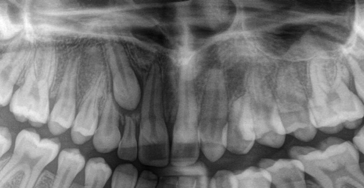 Abb. 7  Im OPG ist die Retention des Zahns 13 sicher zu diagnostizieren.