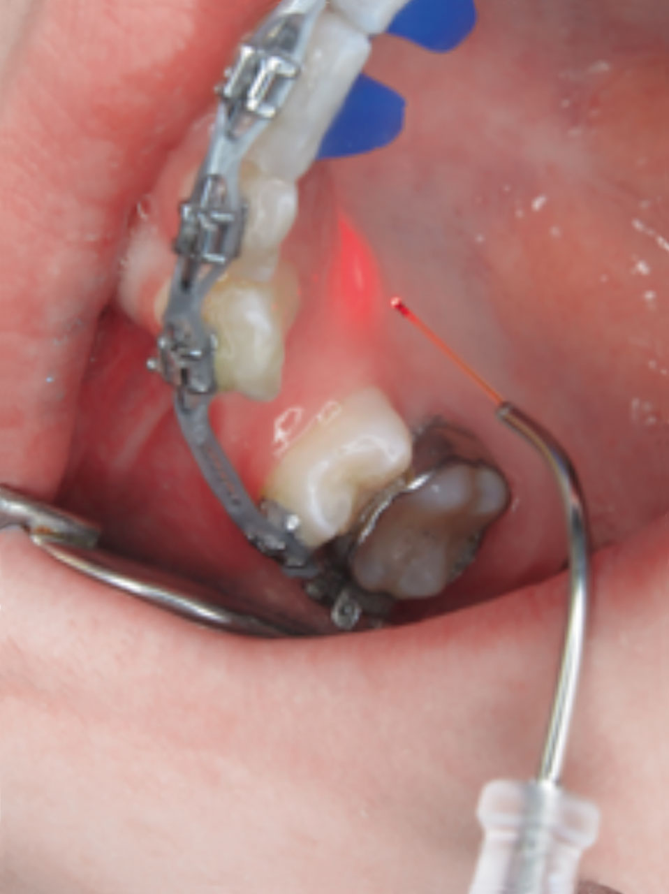 Abb. 23  Biostimulation, der Extraktionslücken im Gegenkiefer zur beschleunigten Zahn­bewegung ...