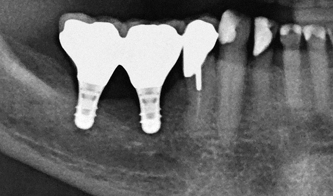 Abb. 4  Kurze Implantate mit langer Krone. n diesem Fall erfolgt die Führung in Latero­trusion über die natürlichen Zähne.