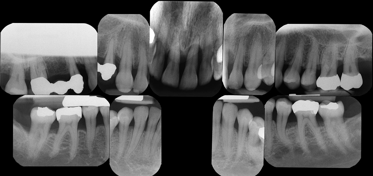 Abb. 1   31-jährige Patientin wird seit 15 Jahren wegen juveniler Parodontitis behandelt und jetzt wegen Progression an Zahn 21 überwiesen. Parodontale Probleme bestehen nicht nur an Zahn 21: (a) Zahnhartsubstanzbefund und Parodontalstatus  (ST – Sondierungstiefen, AL – Attachmentlevel); (b) Röntgenstatus.