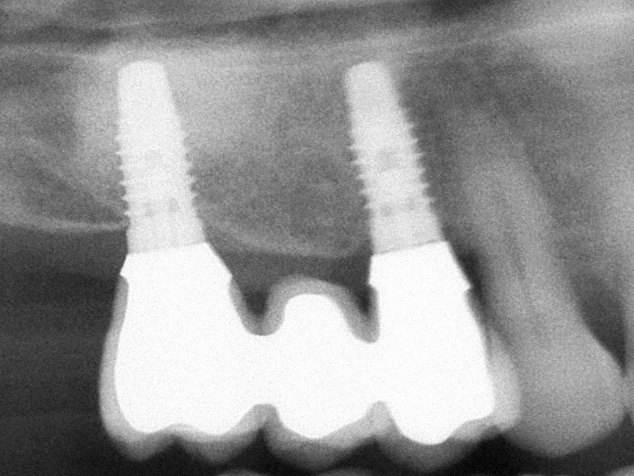 Abb. 3  Das Röntgenbild der Suprakonstruktion in Abbildung 1 zeigt die gewünschte Achsausrichtung und Position der Implantate.