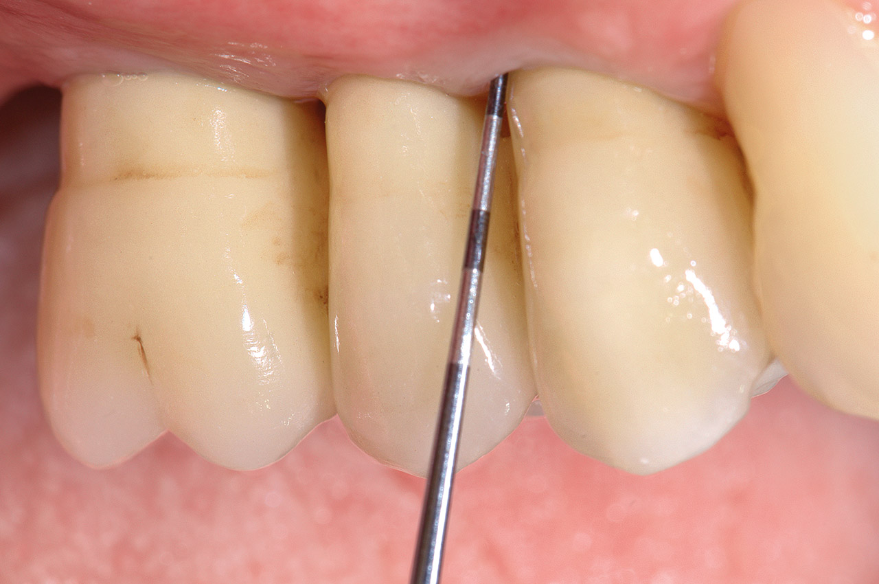 Abb. 4  Durch einfachen Zugang mit der Parodontalsonde ist die regelmäßige Sondierung im Recall möglich.