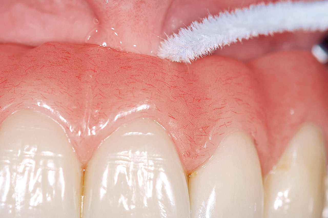 Abb. 5  Die häusliche Mundhygiene verschraubter Prothesen ist besonders für alte Patienten schwierig.