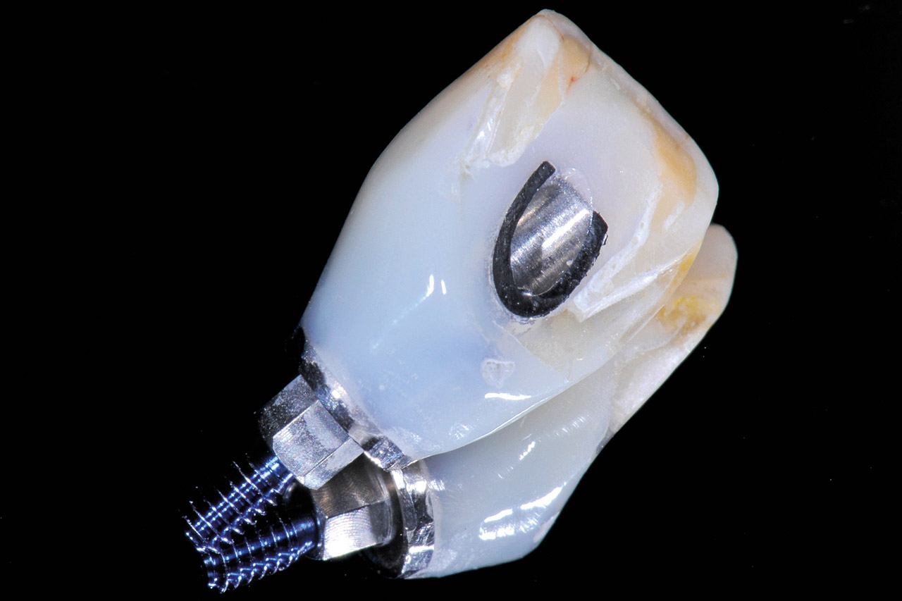 Abb. 17  Auch bei Frontzähnen ist eine Verschraubung durch kleinere Abutmentschrauben bei richtiger Implantatposition möglich.