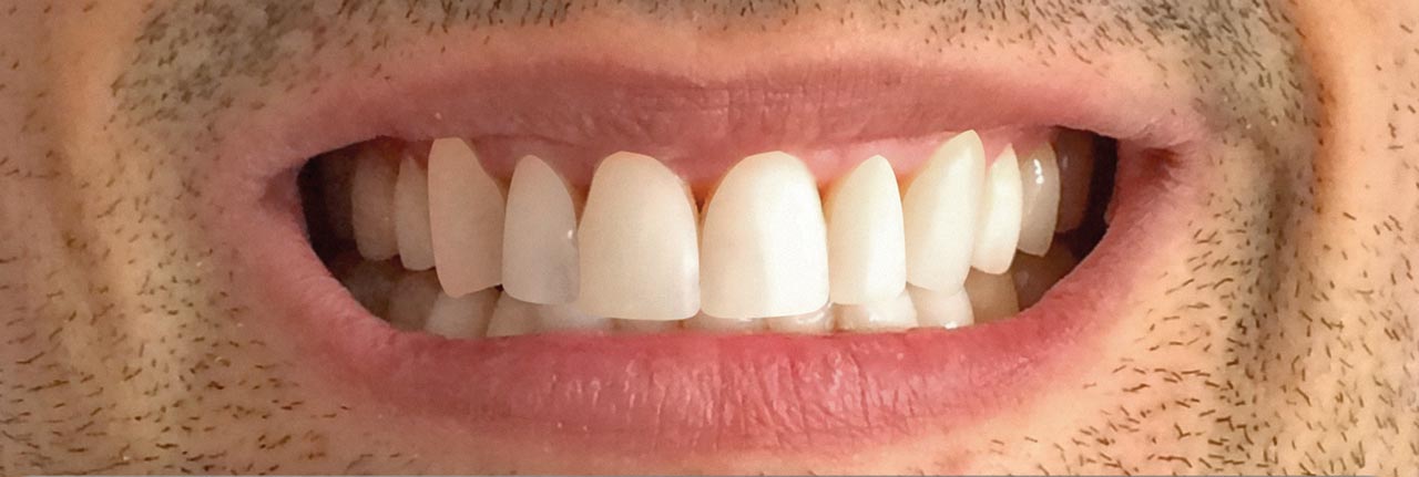 Abb. 11 Sichtbar schönere Zähne für den Patienten (einfache Simulation)