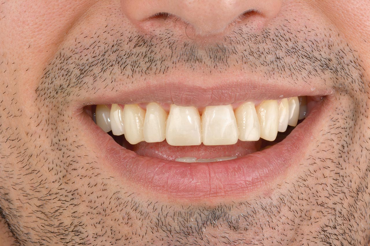 Abb. 33 Der Patient mit simulierten Zähnen (Mock-up)