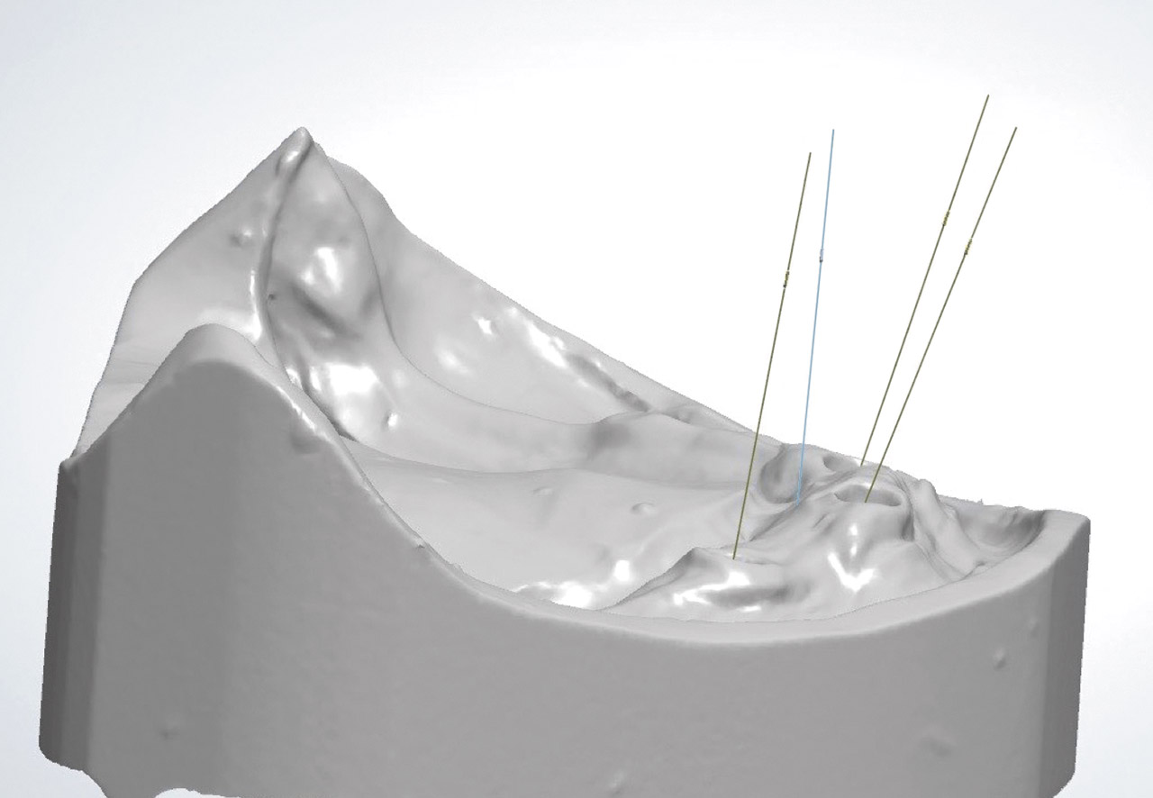 Abb. 15 CAD/CAM-Design der Stegkonstruktion (Einschub­richtung der Implantatachsen)