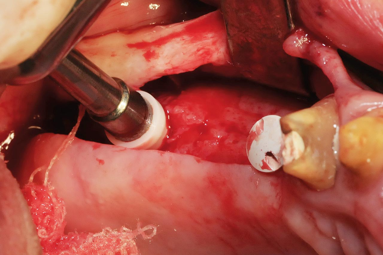 Abb. 22 Implantatinsertion