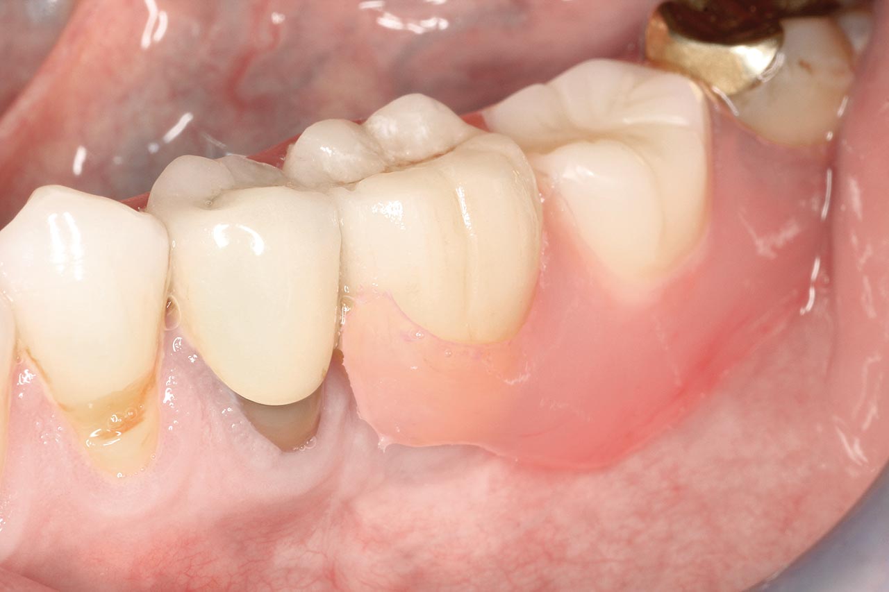 Abb. 10 Polyamidprothesenklammer am Zahn 36.