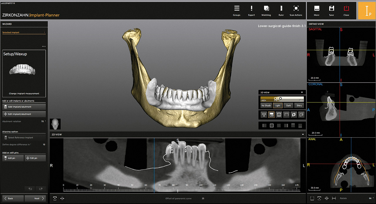 Abb. 5 Die Zahnaufstellung nach dem Matching auf Modellscans, Gesichtsscans und DICOM-Daten im Zirkonzahn.Implant-Planner.