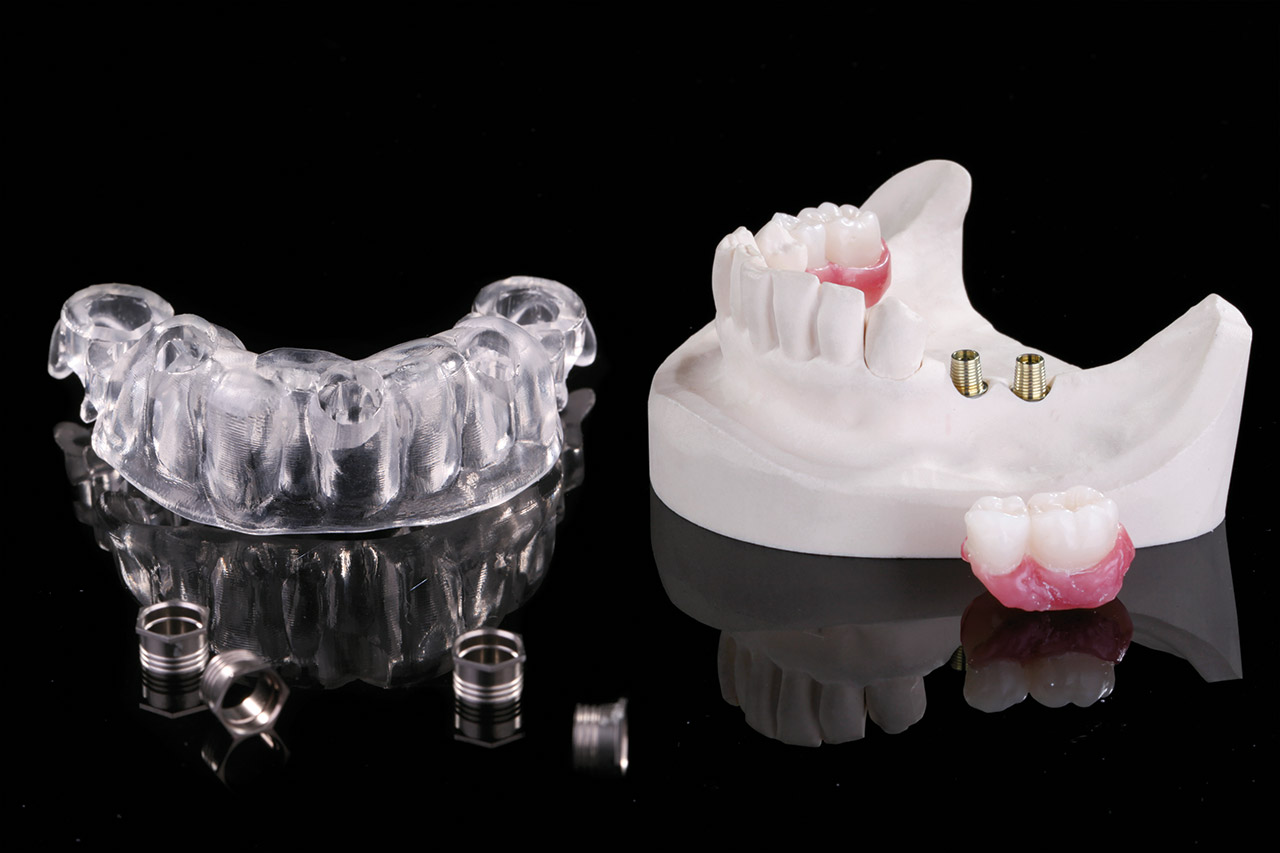 Abb. 34 Dank des Implant-Planners wird es in Kürze möglich sein, dem Zahnarzt das zahntechnische Gesamtpaket zur Behandlung von Implantatfällen zeitgleich zu übergeben: Bohrschablone, individueller Abformlöffel, Modell mit Implantatanalogen und (bei Bedarf) Provisorium.