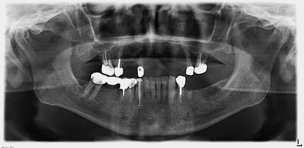 Abb. 1 Planung: Orthopantomogramm (OPG) mit nicht erhaltungswürdigen Zähnen 12, 45 und 47.