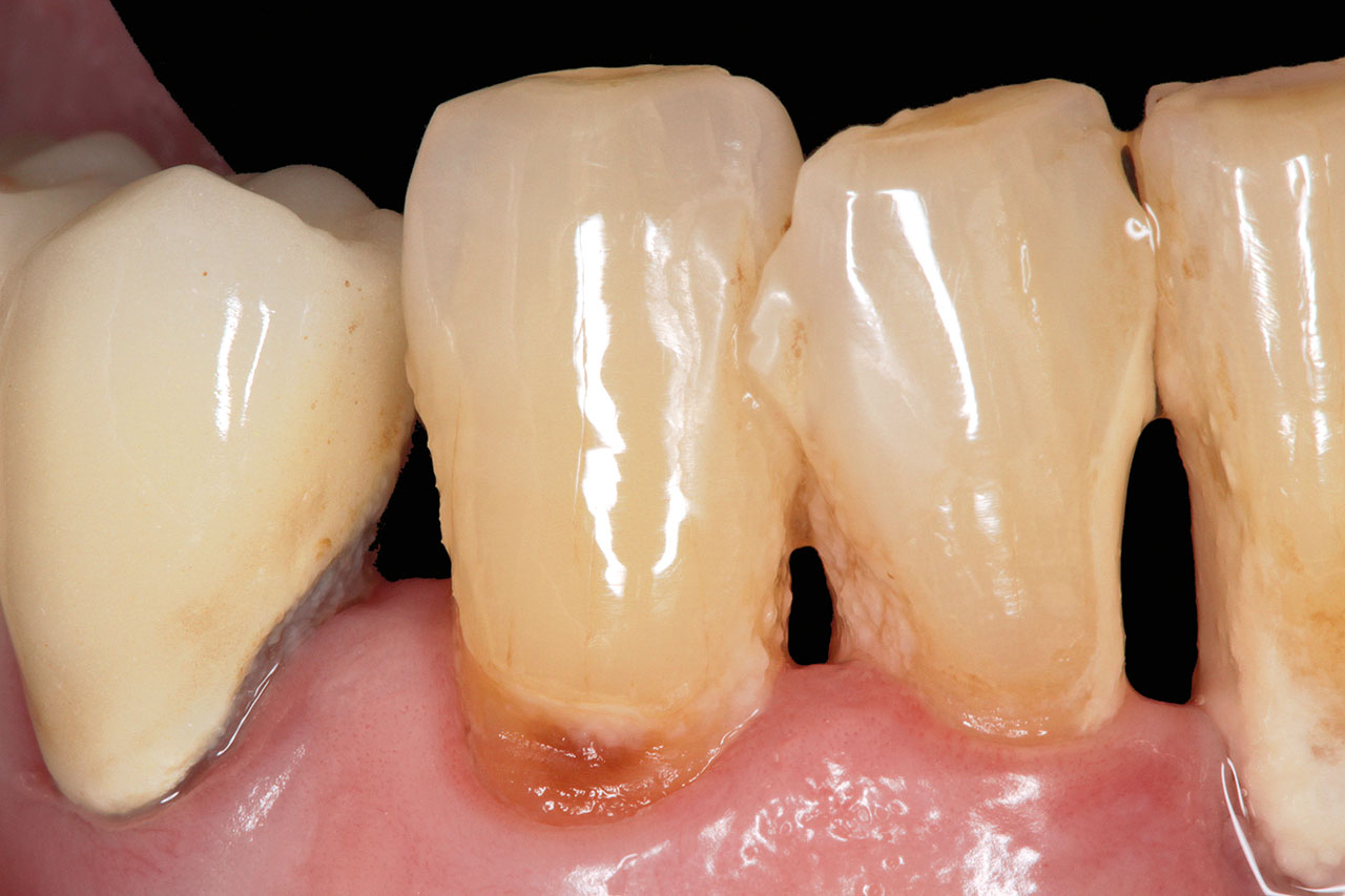 Abb. 5 Typische Alterserscheinungen an Zähnen: Kombination aus mangelnder Zahnpflege und initialer Glattflächenkaries.