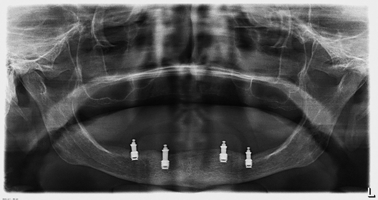 Abb. 15 Zustand 5 Jahre postoperativ: vier kurze Implantate (Short Implant 4,5 x 6,0 mm; Bicon, Boston/USA) bei geringem horizontalen und vertikalen Knochenangebot.