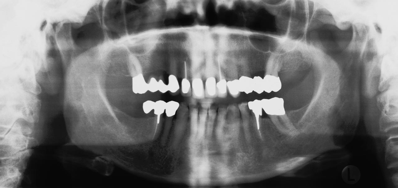 Abb.  1a Übersichtsaufnahme einer 79-jährigen Patientin mit mehreren endodontisch behandelten Zähnen. Auffällig ist, dass immer mehr ältere Patienten ihre vollständige Dentition bis in das hohe Alter behalten oder nur wenige Zähne fehlen.