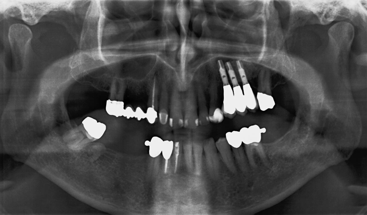Abb. 1b Die Kombination aus restaurativen, endodontischen, prothetischen und implantologischen Maßnahmen kann vielen Patienten bis ins hohe Alter Kaukomfort und Lebensqualität erhalten. Übersichtsaufnahme eines 76-jährigen Patienten. 