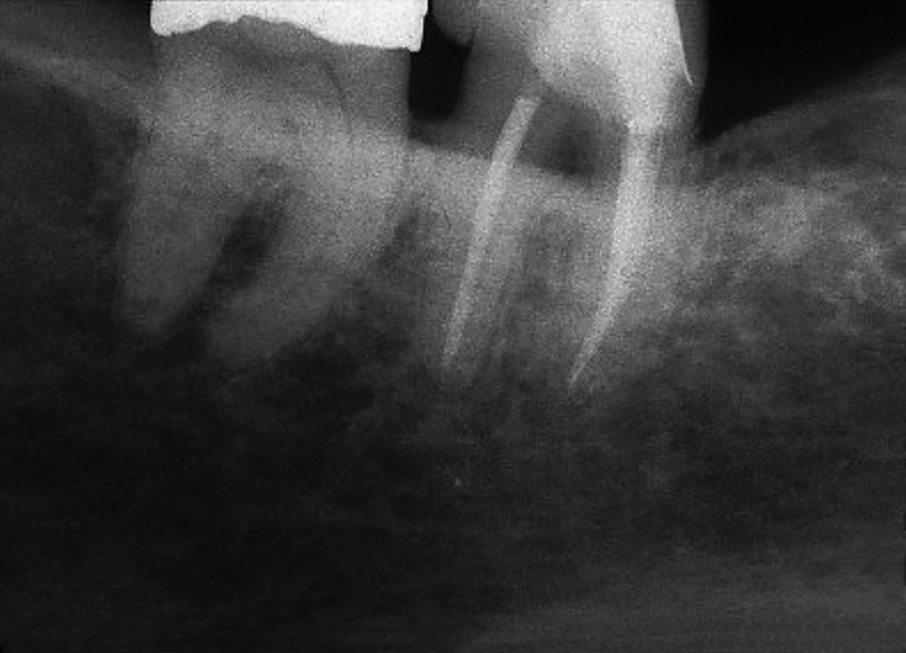 Abb. 2b Röntgenkontrolle zwei Jahre nach der Wurzelkanalbehandlung: Der Zahn ist klinisch und radiologisch symptomfrei. Die koronale Versorgung besteht nach wie vor aus einer Adhäsivrestauration.