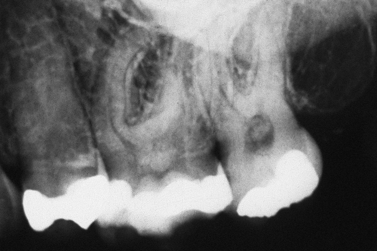 Abb. 4a Ausgeprägter Dentikel in der Pulpakammer einer 62-jährigen Patientin.