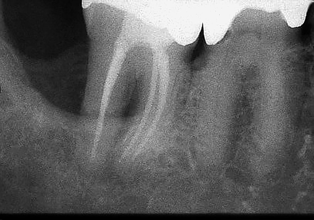 Abb. 1b Die Röntgenkontrolle nach 4 Jahren zeigt eine unveränderte parodontale Situation. Der Zahn ist nicht gelockert, zeigt keine apikale Läsion und ist voll funktionsfähig.