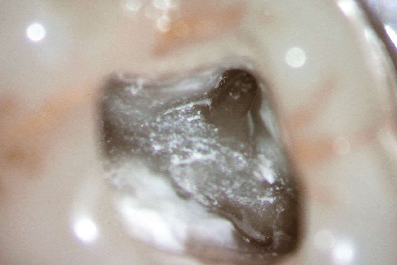 Abb. 6d Nach Entfernung des Hartgewebes aus dem Pulpakavum konnten die Wurzelkanaleingänge dargestellt werden.
