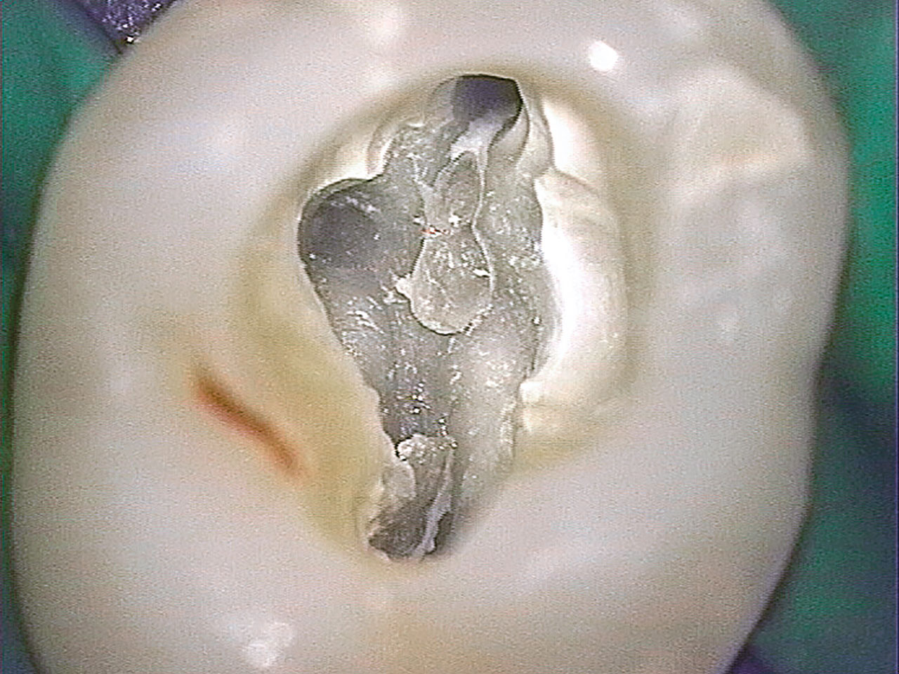 Abb. 7 Fallen solch kleine Dentikel (Pfeile) in den Wurzelkanal, können irreversible Blockaden mit Verlust an Arbeitslänge und unvollständiger Desinfektion und Obturation resultieren.