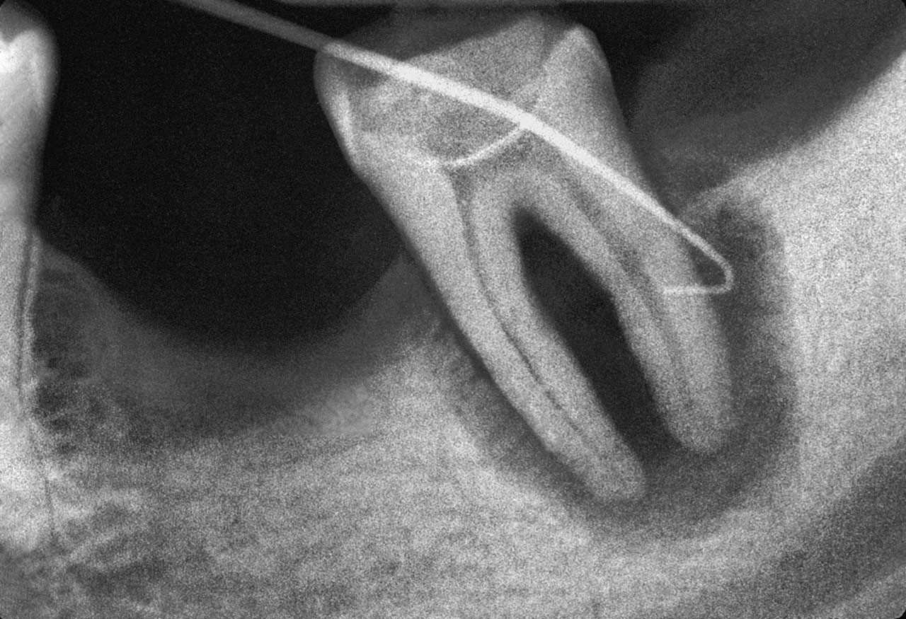 Abb. 10a Präoperative Aufnahme des Zahnes 36 mit ausgedehnter Endo-Paro-Läsion endodontischen Ursprungs.
