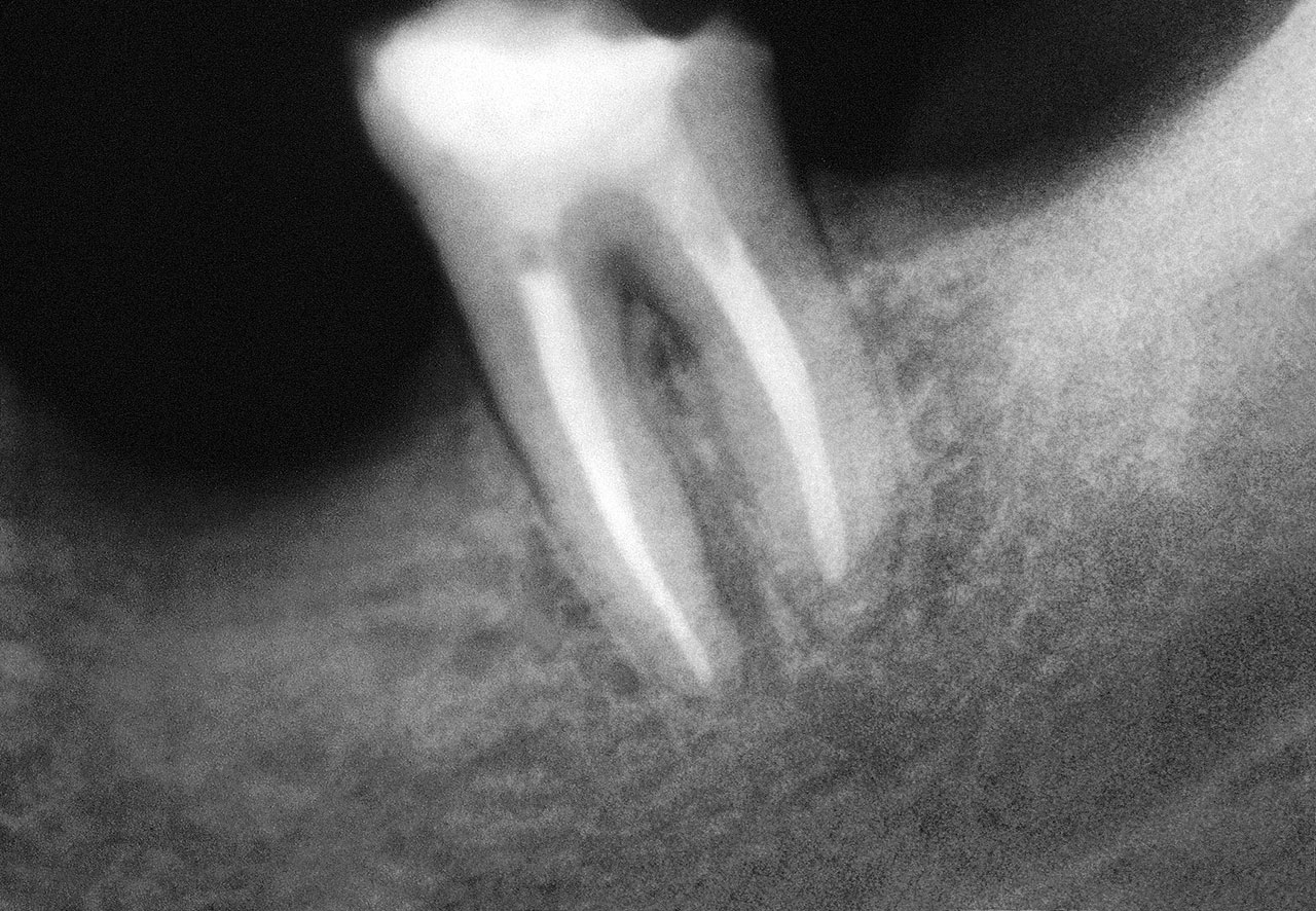 Abb. 10b Die 3-Jahreskontrolle (nach Verlust der Krone) zeigt die röntgenologisch vollständige Heilung der Läsion. Der Zahn ist voll funktionsfähig.