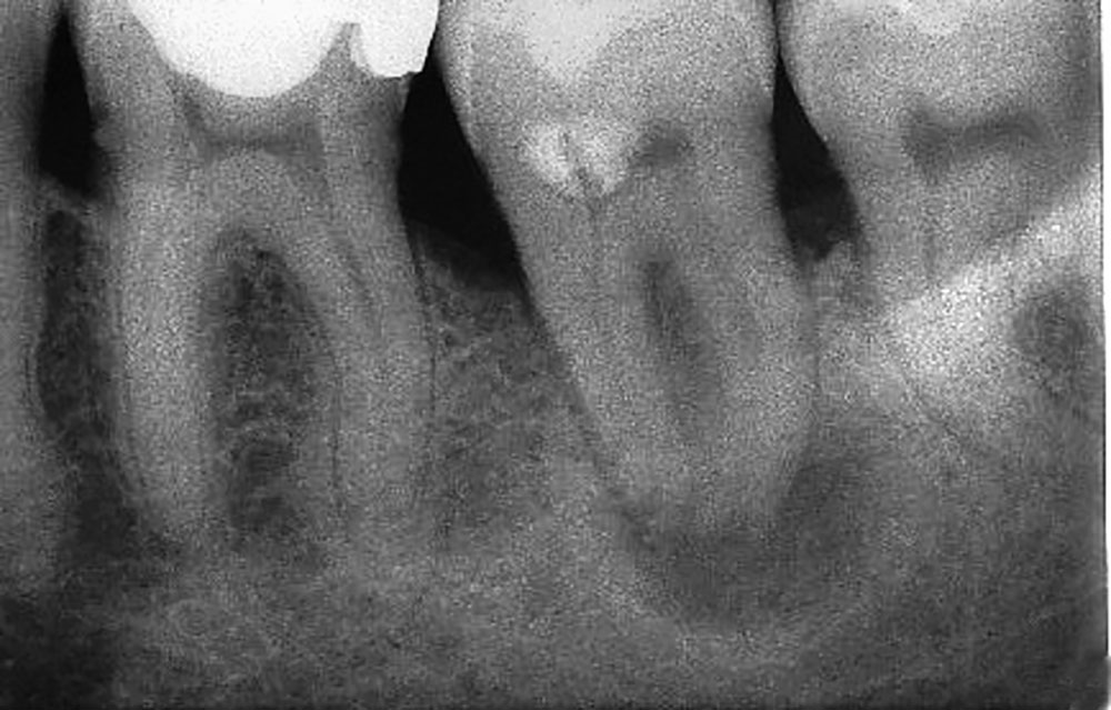 Abb. 11a Kontrollaufnahme nach Wurzelkanalbehandlung an Zahn 37.