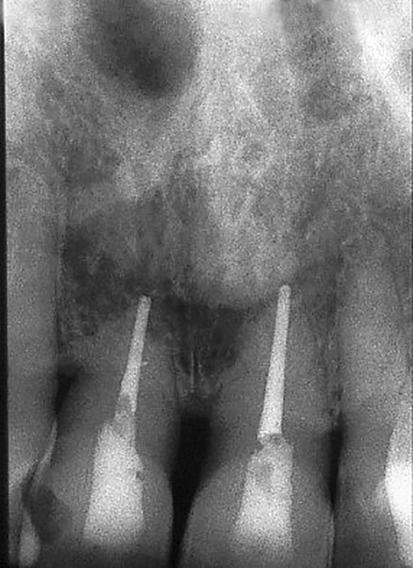 Abb. 12b Die Kontrollaufnahme 4 Jahre nach Replantation und Wurzelkanalbehandlung der beiden Frontzähne zeigt eine gute Einheilung der beiden Zähne.