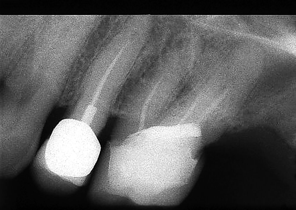 Abb. 13a Präoperative Aufnahme der Zähne 25 und 26 mit insuffizienten Wurzelkanalbehandlungen bei einem 61-jährigen Patienten. 