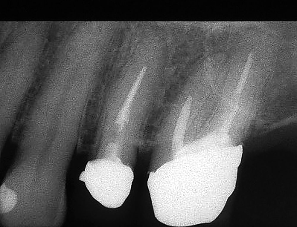 Abb. 13b Trotz nicht optimaler Erschließung der kalzifizierten Wurzelkanäle entwickelten sich keine pathologischen Veränderungen an den beiden Zähnen.
