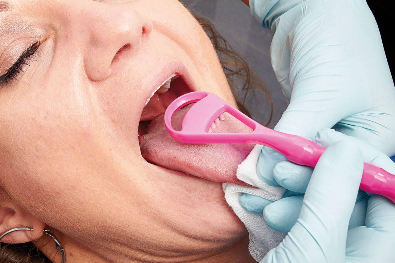 Abb. 3 Zungenreinigung mit Hilfe einer Zungenbürste durch  Prophylaxeassistenz.