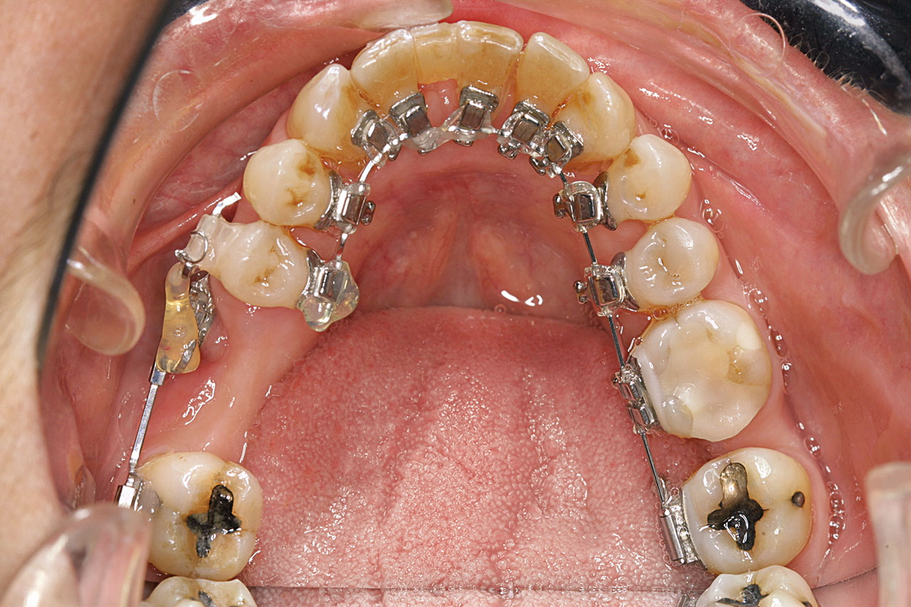 Abb. 7 Linguale Multibracketapparatur in situ nach Extraktion von Zahn 41, der nach Extraktion und Wurzelentfernung aus ästhetischen Gründen adhäsiv an Zahn 42 befestigt und von Termin zu Termin mesiodistal reduziert wurde. 