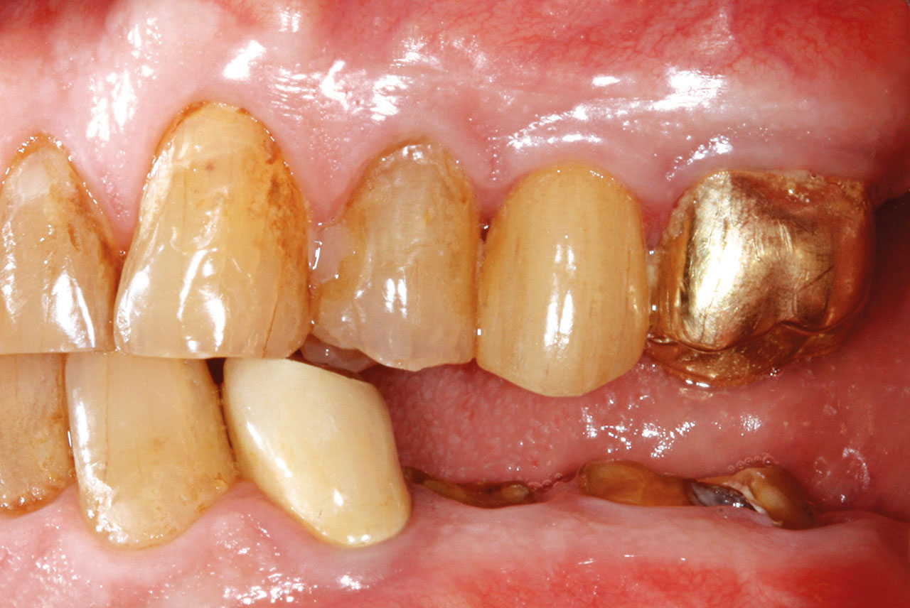 Abb. 1d Klinische Situation bei der Erstvorstellung: generalisiert zervikale kariöse Läsionen, epigingival frakturierte Zähne 35 und 36, ausgedehnte Kronenrandkaries am Zahn 47 (Zustand nach Entfernung der Krone).