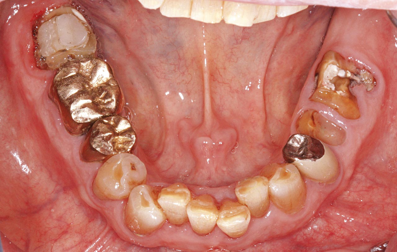 Abb. 1e Klinische Situation bei der Erstvorstellung: generalisiert zervikale kariöse Läsionen, epigingival frakturierte Zähne 35 und 36, ausgedehnte Kronenrandkaries am Zahn 47 (Zustand nach Entfernung der Krone).