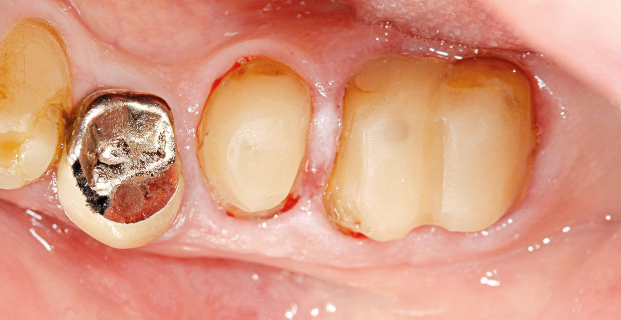 Abb. 5a bis f Operatives Vorgehen zur Prämolarisierung des Zahnes 36 und chirurgische Kronenverlängerung der Zähne 35 und 36. Präoperative Ansicht, ...