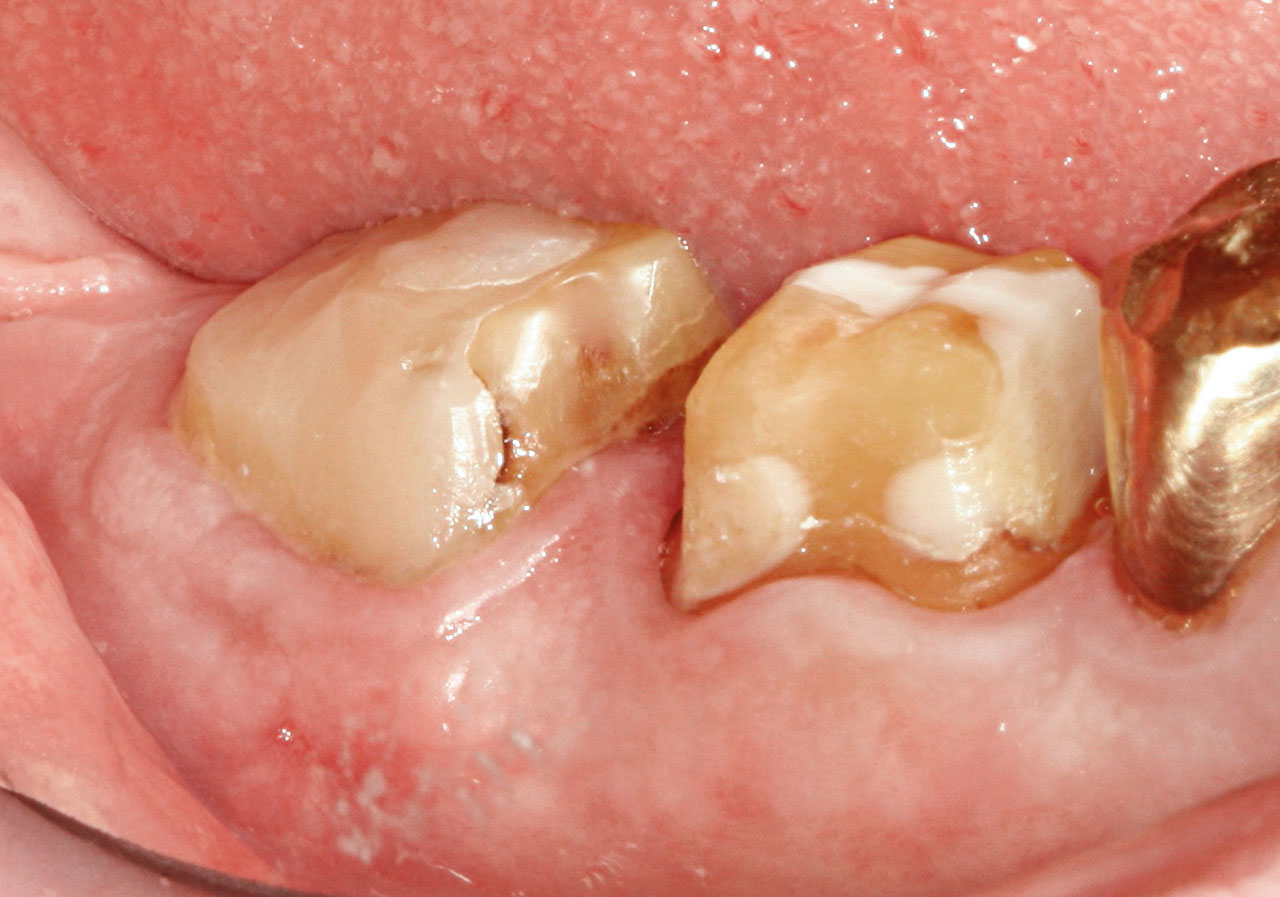 Abb. 6a bis f Operatives Vorgehen zur Hemisektion des Zahnes 47 und chirurgische Kronenverlängerung der Zähne 46 und 47. Präoperative Ansicht, ...