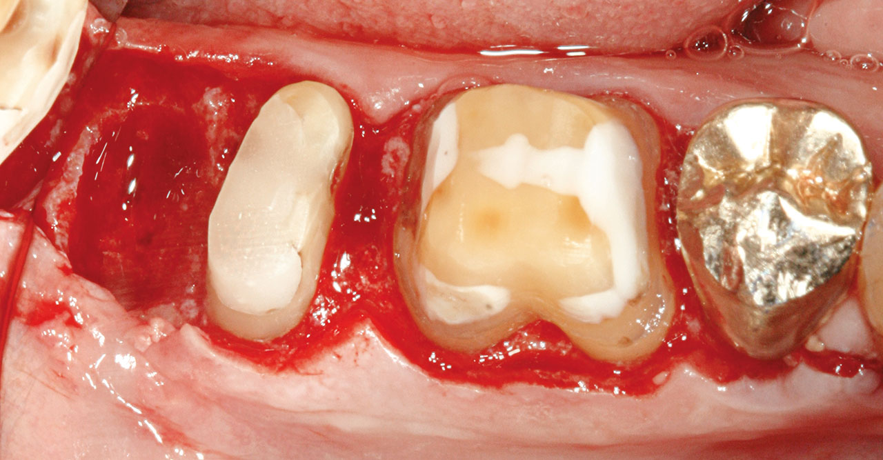 Abb. 6d ... Situation nach Hemisektion der distalen Wurzel von Zahn 47, Odontoplastik und Knochenresektion, ...