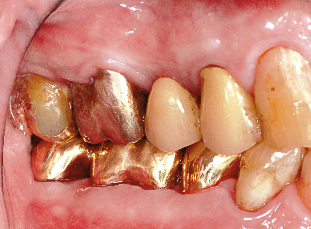 Abb. 7b Klinische Situation nach prothetischer Versorgung des prämolarisierten Zahnes 36 und des Zahnes 35 mit verblockten Goldkronen sowie Verblockung des hemisezierten Zahnes 47 mit dem Zahn 46.