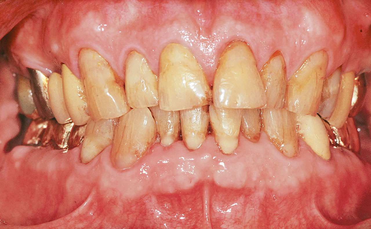Abb. 7c Klinische Situation nach prothetischer Versorgung des prämolarisierten Zahnes 36 und des Zahnes 35 mit verblockten Goldkronen sowie Verblockung des hemisezierten Zahnes 47 mit dem Zahn 46.