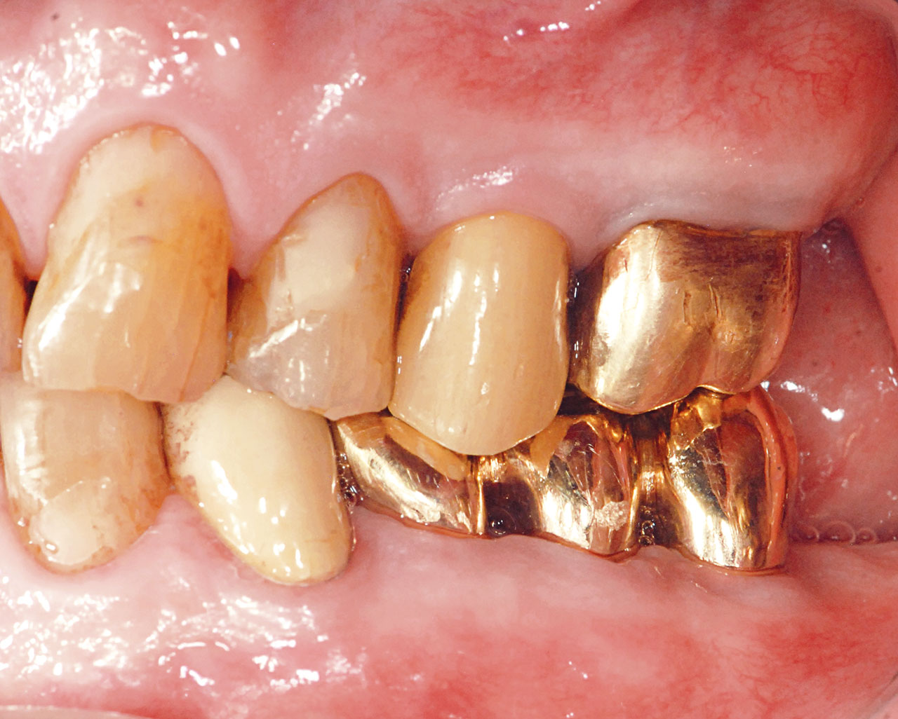 Abb. 7d Klinische Situation nach prothetischer Versorgung des prämolarisierten Zahnes 36 und des Zahnes 35 mit verblockten Goldkronen sowie Verblockung des hemisezierten Zahnes 47 mit dem Zahn 46.
